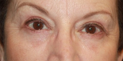 Blepharoplasty Before & After Patient #20207
