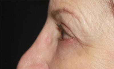 Blepharoplasty Before & After Patient #20207