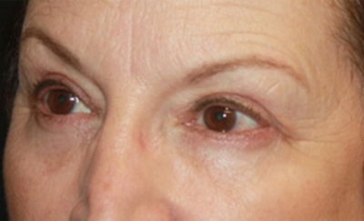 Blepharoplasty Before & After Patient #20207