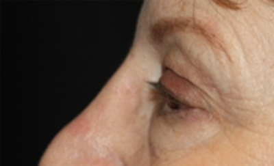 Blepharoplasty Before & After Patient #20207