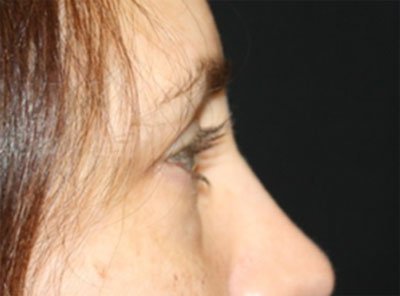 Blepharoplasty Before & After Patient #20215