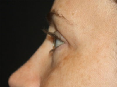 Blepharoplasty Before & After Patient #20215