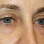 Blepharoplasty Before & After Patient #20215