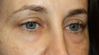 Blepharoplasty Before & After Patient #20215