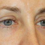 Blepharoplasty Before & After Patient #20215