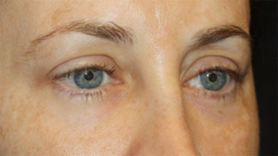 Blepharoplasty Before & After Patient #20215