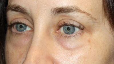 Blepharoplasty Before & After Patient #20215