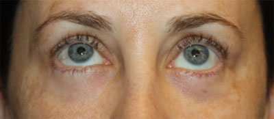 Blepharoplasty Before & After Patient #20215