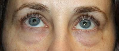 Blepharoplasty Before & After Patient #20215