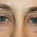 Blepharoplasty Before & After Patient #20215