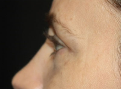 Blepharoplasty Before & After Patient #20215