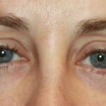 Blepharoplasty Before & After Patient #20215