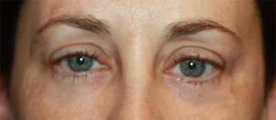 Blepharoplasty Before & After Patient #20215