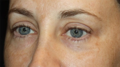 Blepharoplasty Before & After Patient #20215