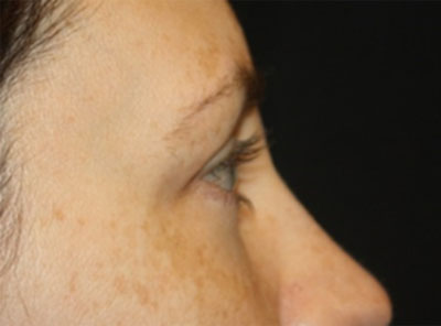 Blepharoplasty Before & After Patient #20215