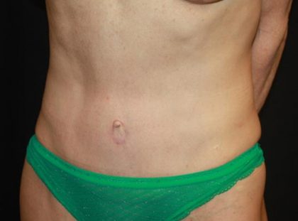 Tummy Tuck Before & After Patient #22629