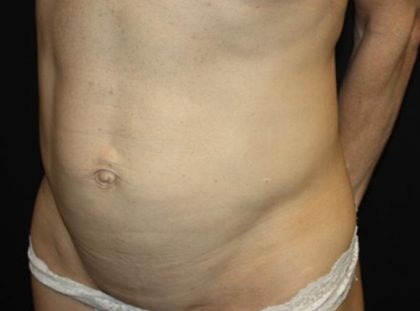 Tummy Tuck Before & After Patient #22629