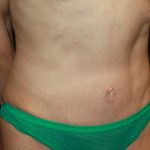 Tummy Tuck Before & After Patient #22629