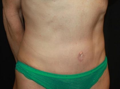 Tummy Tuck Before & After Patient #22629