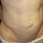 Tummy Tuck Before & After Patient #22629