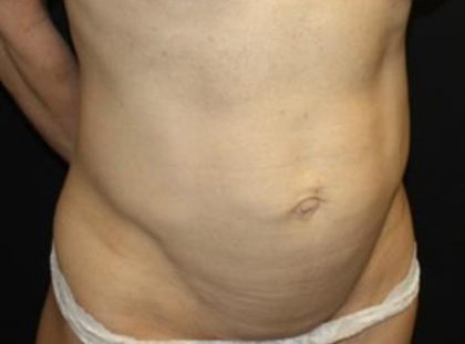 Tummy Tuck Before & After Patient #22629