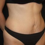 Tummy Tuck Before & After Patient #22640