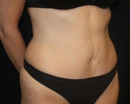 Tummy Tuck Before & After Patient #22640