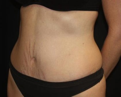 Tummy Tuck Before & After Patient #22640