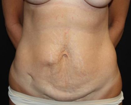 Tummy Tuck Before & After Patient #22640