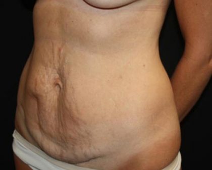 Tummy Tuck Before & After Patient #22640