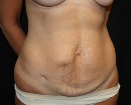 Tummy Tuck Before & After Patient #22640