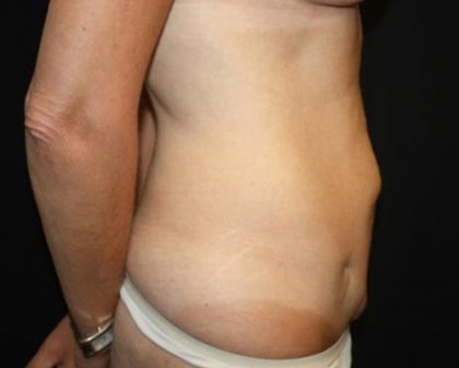 Tummy Tuck Before & After Patient #22640