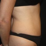 Tummy Tuck Before & After Patient #22640