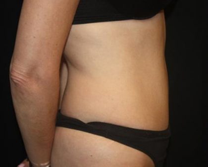 Tummy Tuck Before & After Patient #22640