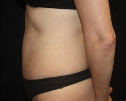 Tummy Tuck Before & After Patient #22640