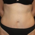 Tummy Tuck Before & After Patient #22640