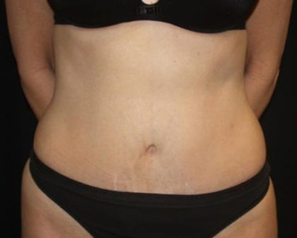 Tummy Tuck Before & After Patient #22640