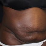 Tummy Tuck Before & After Patient #22236