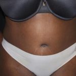 Tummy Tuck Before & After Patient #22236