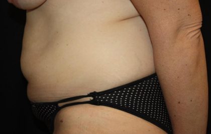 Tummy Tuck Before & After Patient #22399