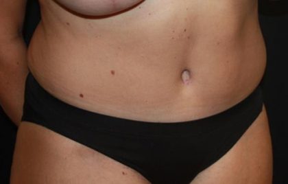 Tummy Tuck Before & After Patient #22399