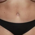 Tummy Tuck Before & After Patient #22399