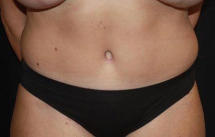 Tummy Tuck Before & After Patient #22399