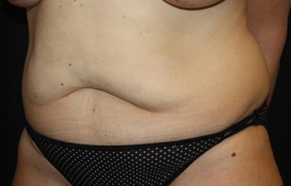 Tummy Tuck Before & After Patient #22399