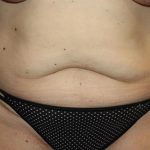 Tummy Tuck Before & After Patient #22399