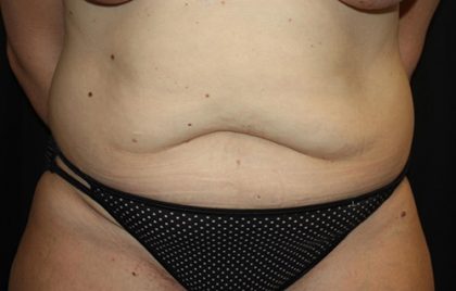 Tummy Tuck Before & After Patient #22399