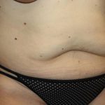 Tummy Tuck Before & After Patient #22399