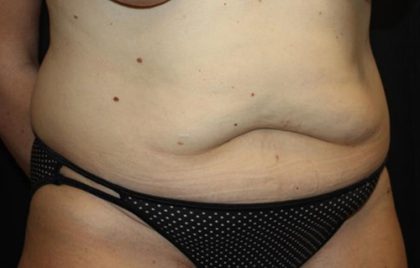 Tummy Tuck Before & After Patient #22399