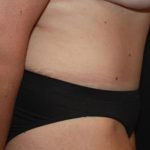 Tummy Tuck Before & After Patient #22399