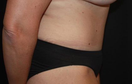 Tummy Tuck Before & After Patient #22399